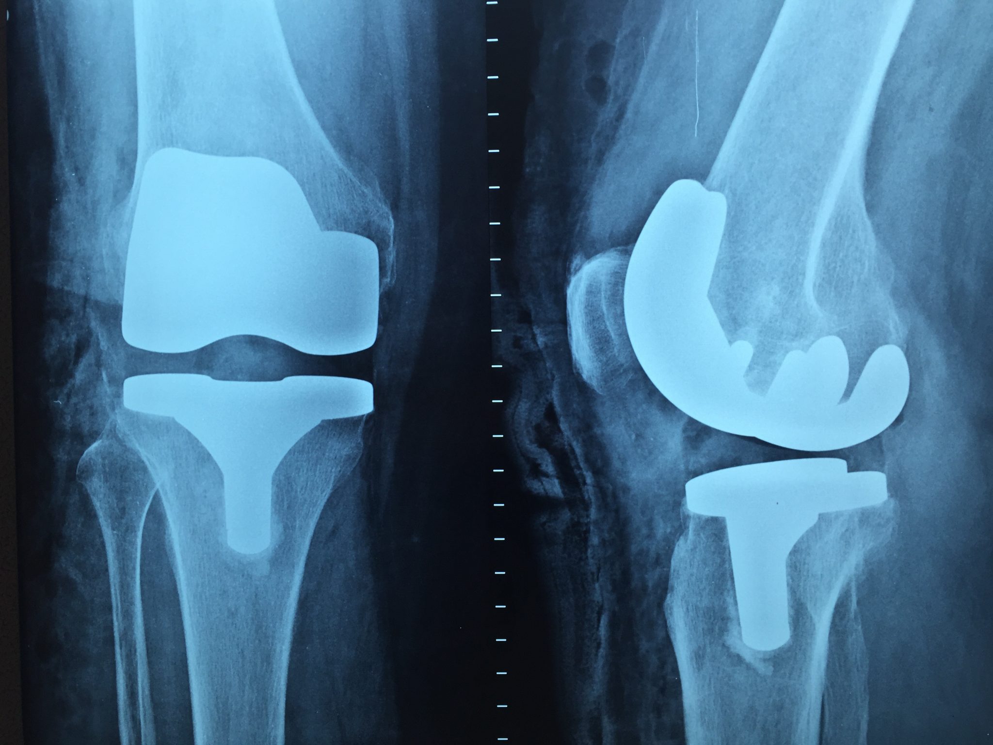 A Ortopedia e o tratamento da osteoartrose Trofa Saúde Hospital Central